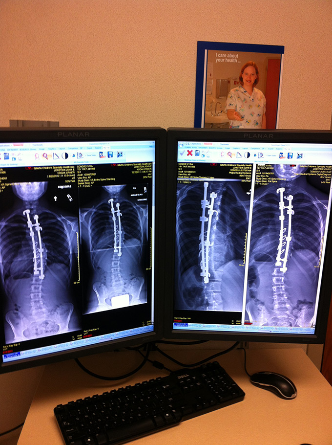 And after spinal fusion surgery.