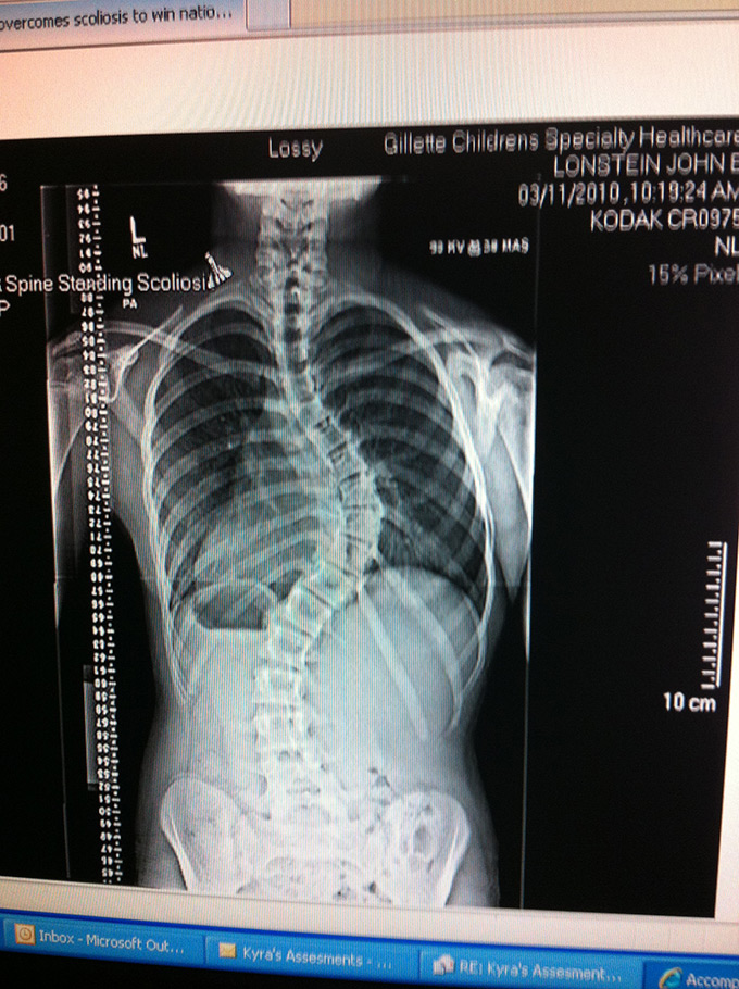 Before spinal fusion surgery with the obvious  's' curve.